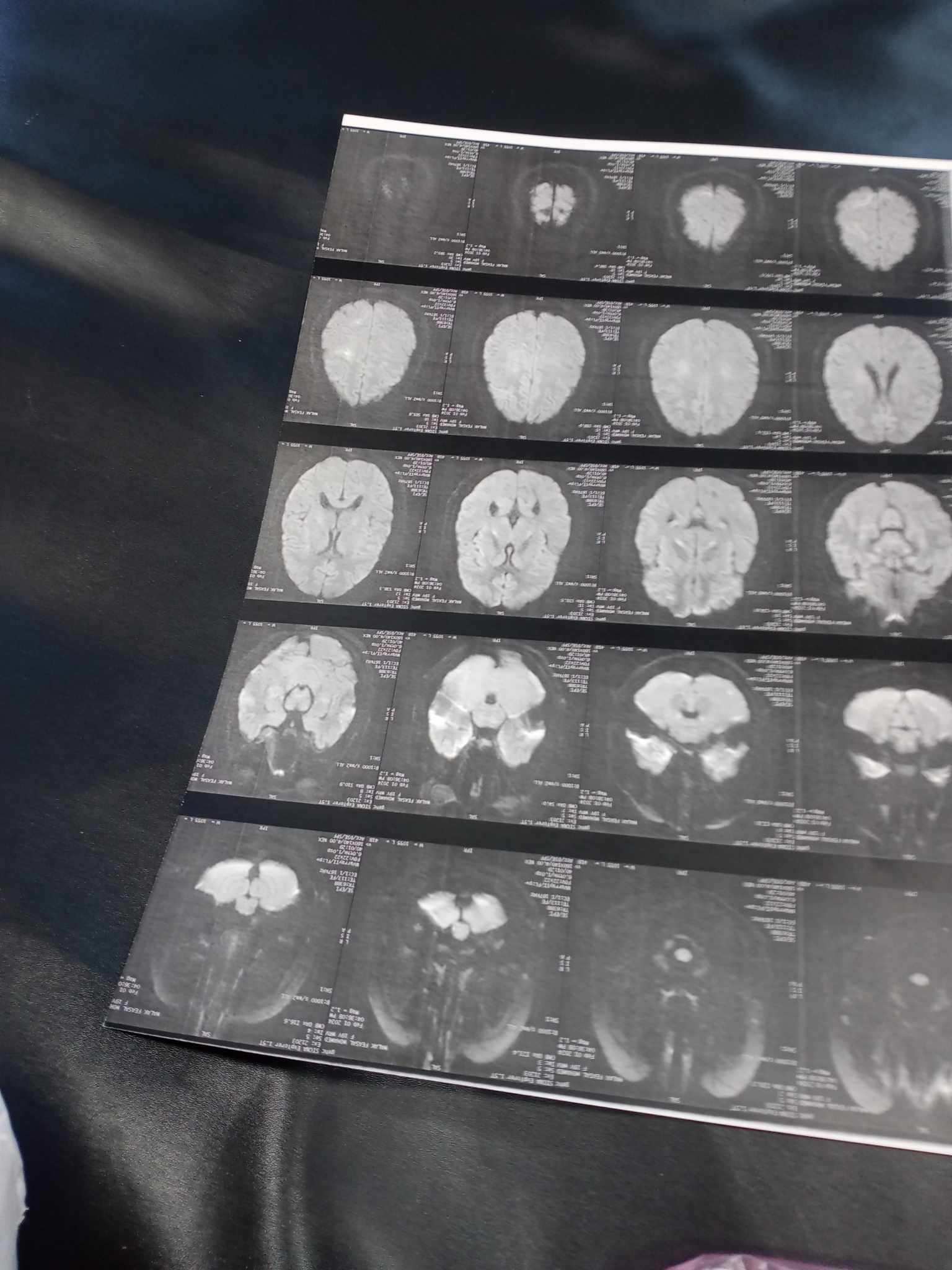 إغماء وتشنجات فى اخر الحمل وتكرر بعد الولادة.. تم عمل رنين على المخ.. ما احتمالات المشكلة؟