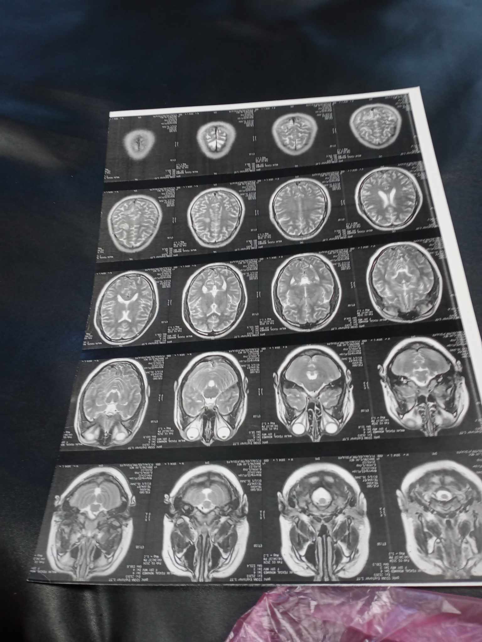 إغماء وتشنجات فى اخر الحمل وتكرر بعد الولادة.. تم عمل رنين على المخ.. ما احتمالات المشكلة؟