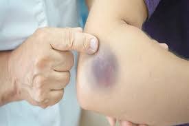 ما سبب ظهور كدمات على الجسم وأي تخصص أتجه إليه للكشف؟