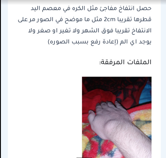 ما سبب هذه الكتلة الكروية التي ظهرت فجأة في يدي؟