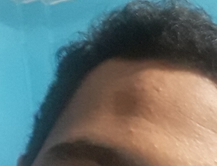 امراض جلديه تصبغ في الجلد