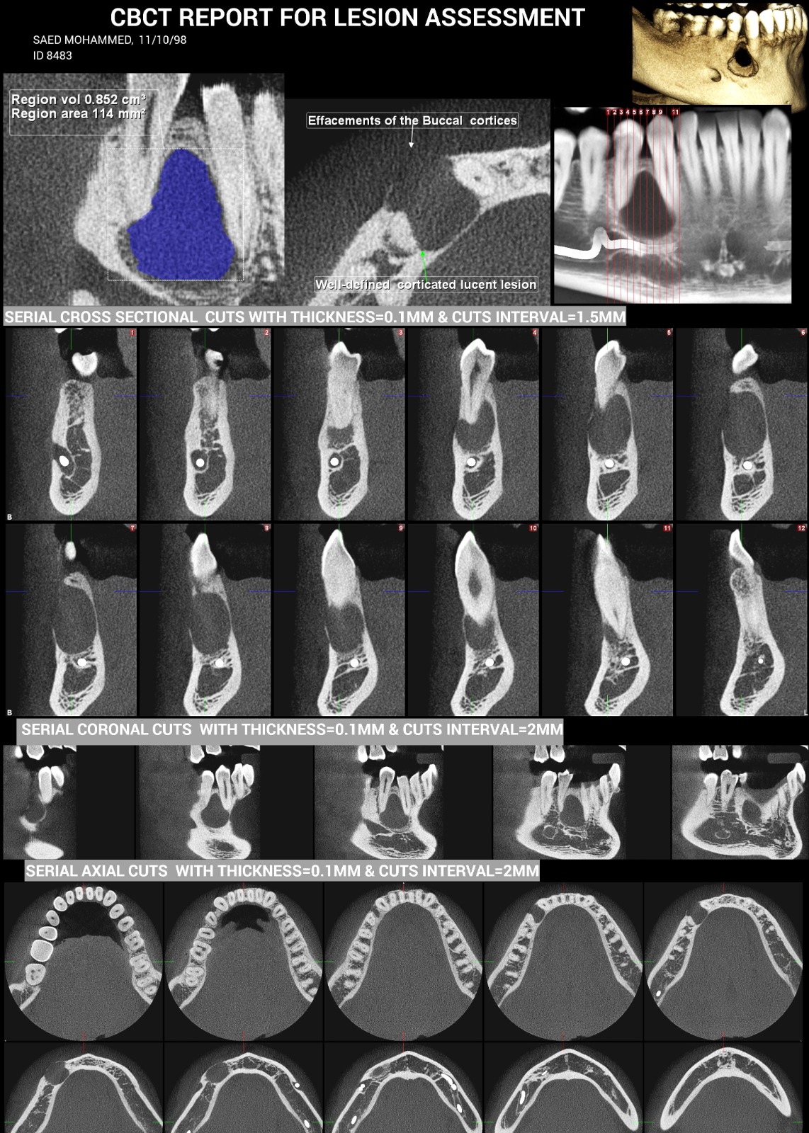 هل هذه التكاليف لعلاج حالة cyst بالأسنان منطقية؟