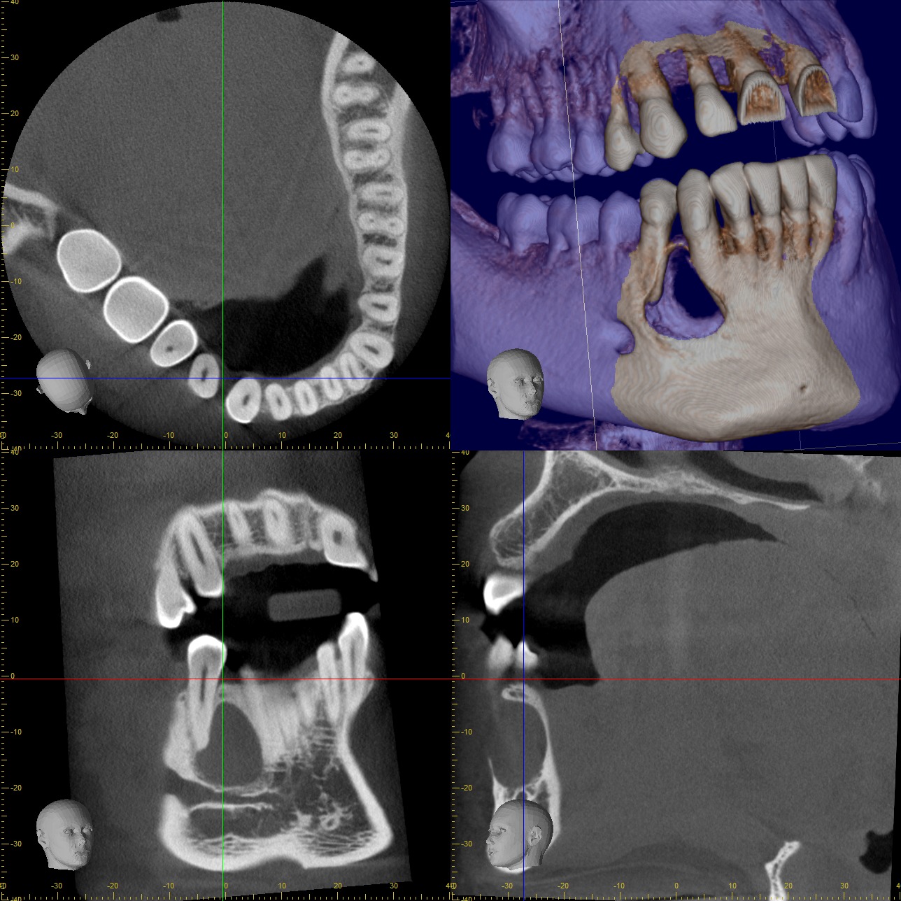 هل هذه التكاليف لعلاج حالة cyst بالأسنان منطقية؟