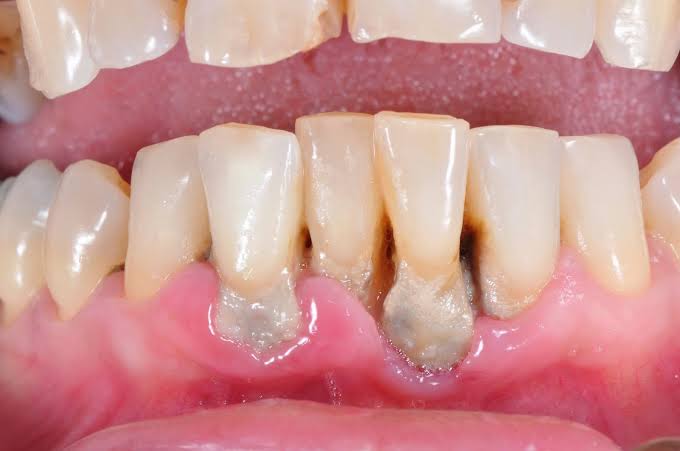 ما علاج تراجع اللثة؟