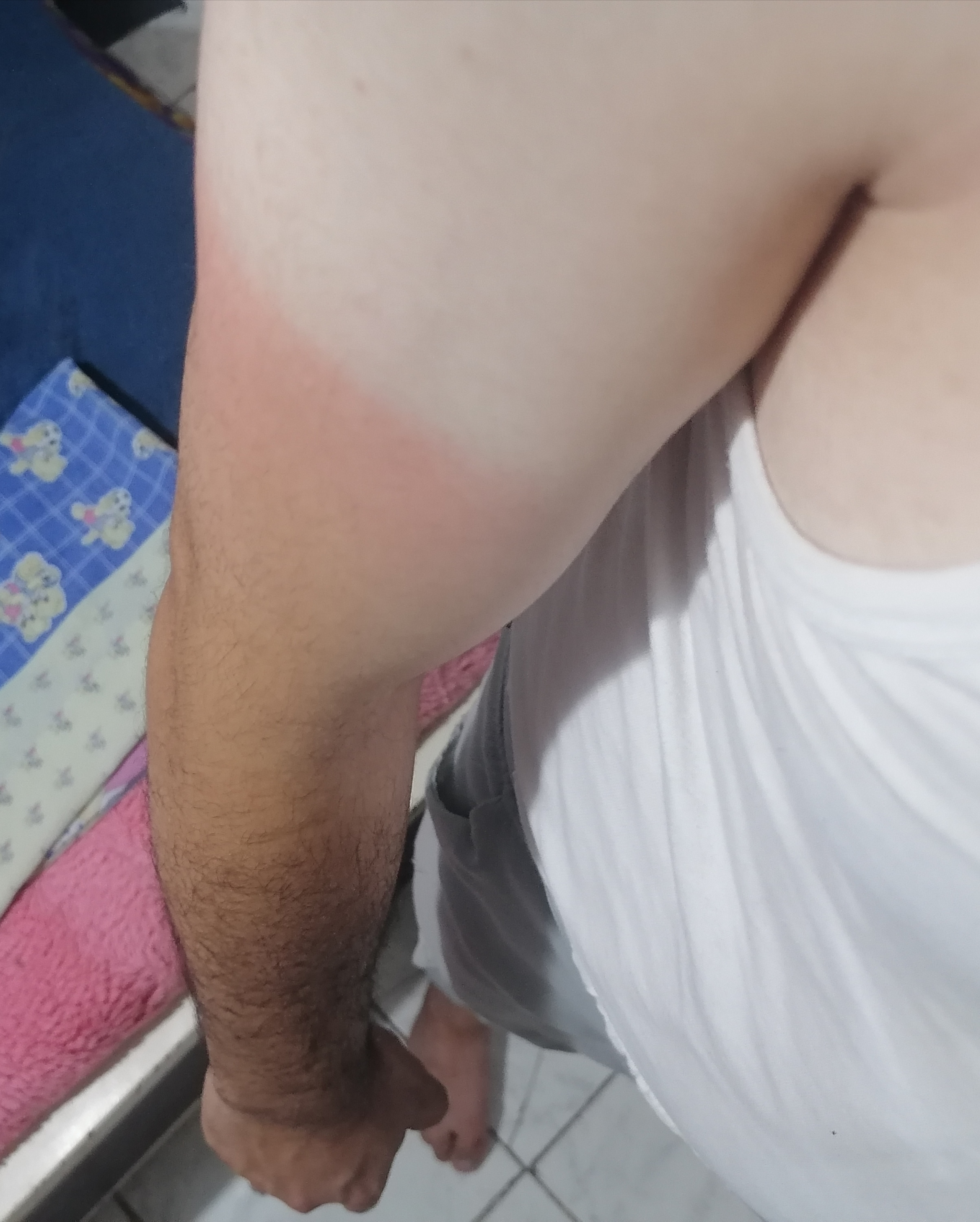 حساسية ولا حروق الشمس ؟!