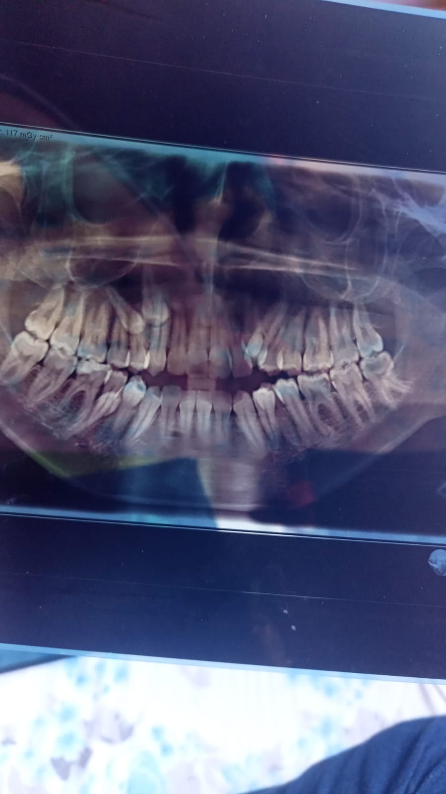 ما تشخيص هذه الأشعة؟