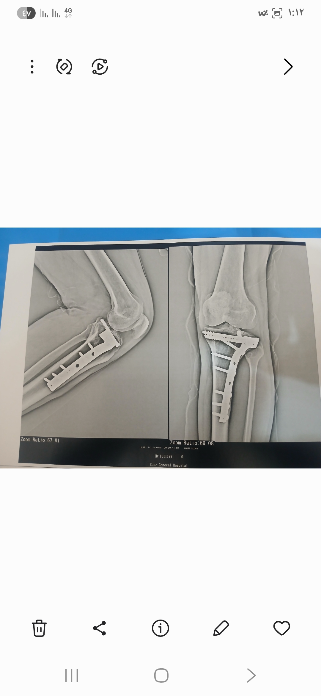 هل يوجد فرق بين صورتي الأشعة؟