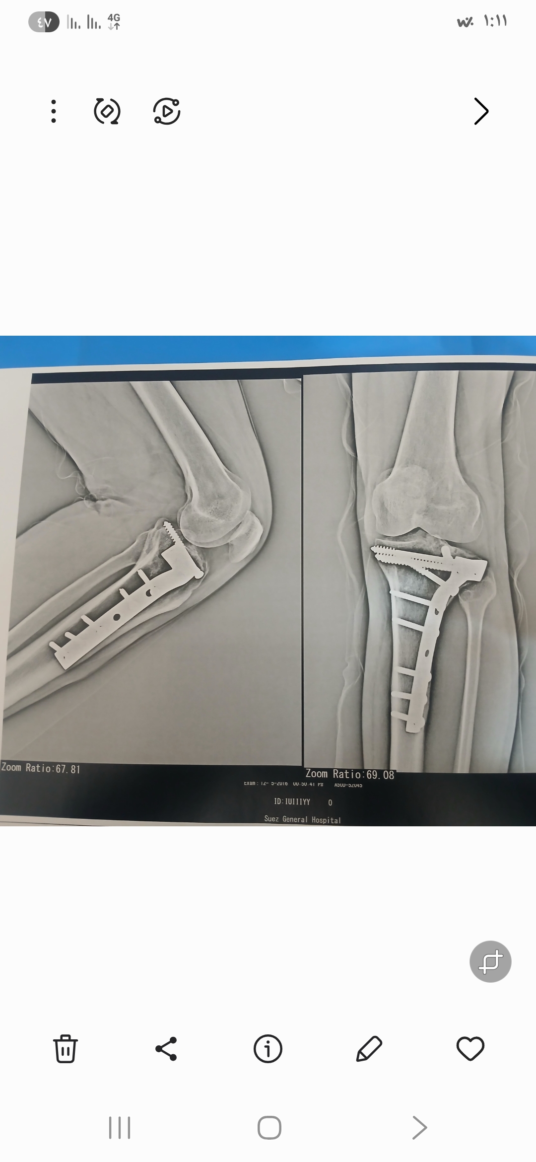 هل يوجد فرق بين صورتي الأشعة؟