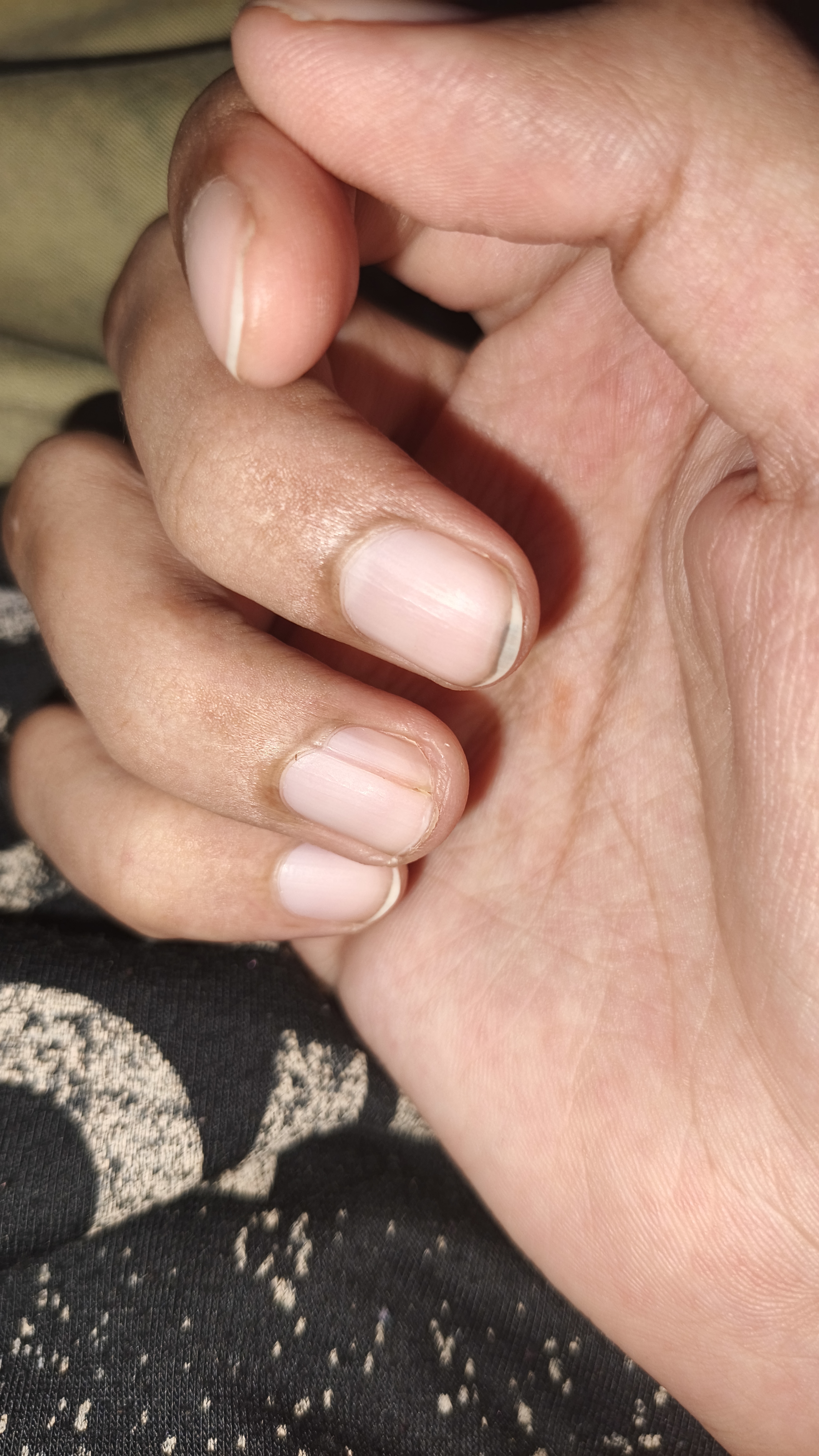 كيف أعالج هذه المشكلة بالأظافر؟