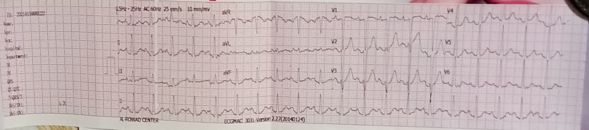 ما العلاج لهذه المشكلة في ضربات القلب وهل هناك مضاعفات؟