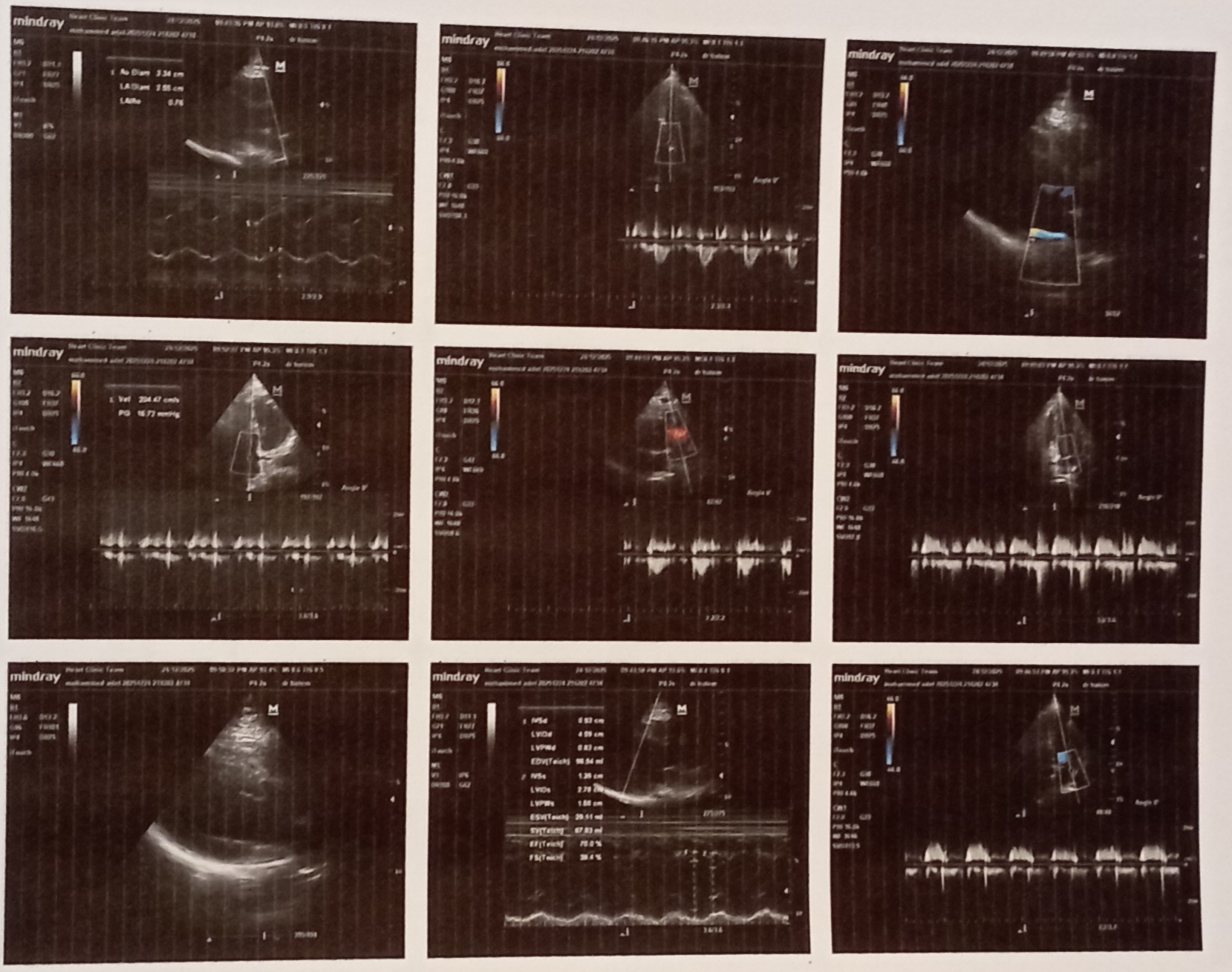 ما العلاج لهذه المشكلة في ضربات القلب وهل هناك مضاعفات؟