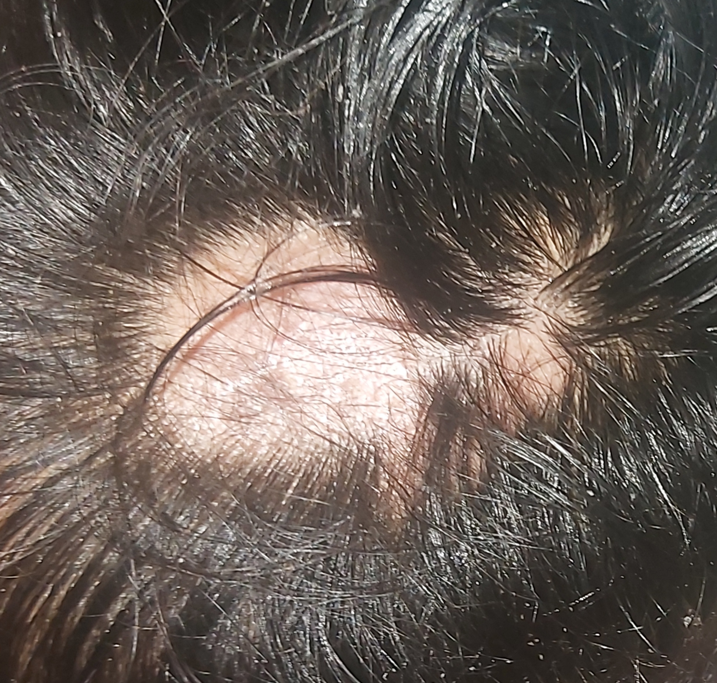 ما علاج الثعلبة؟