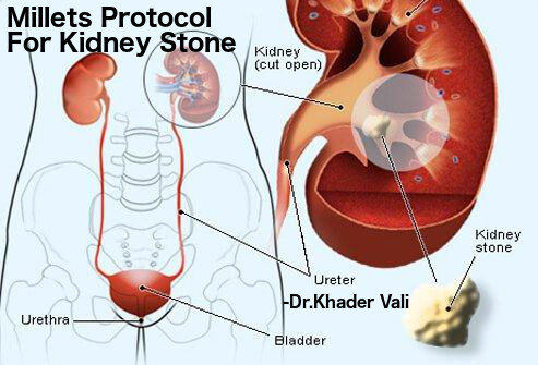 Dr.Khader Vali's Millet Protocol For Kidney Stone