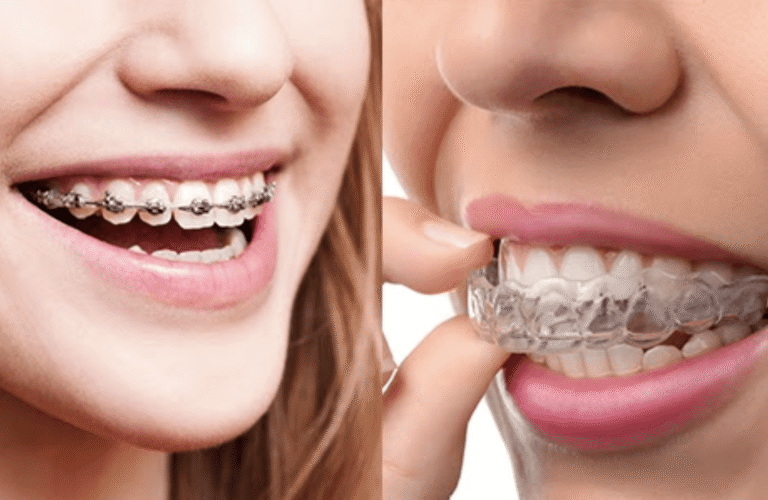 Image for Braces and Aligners