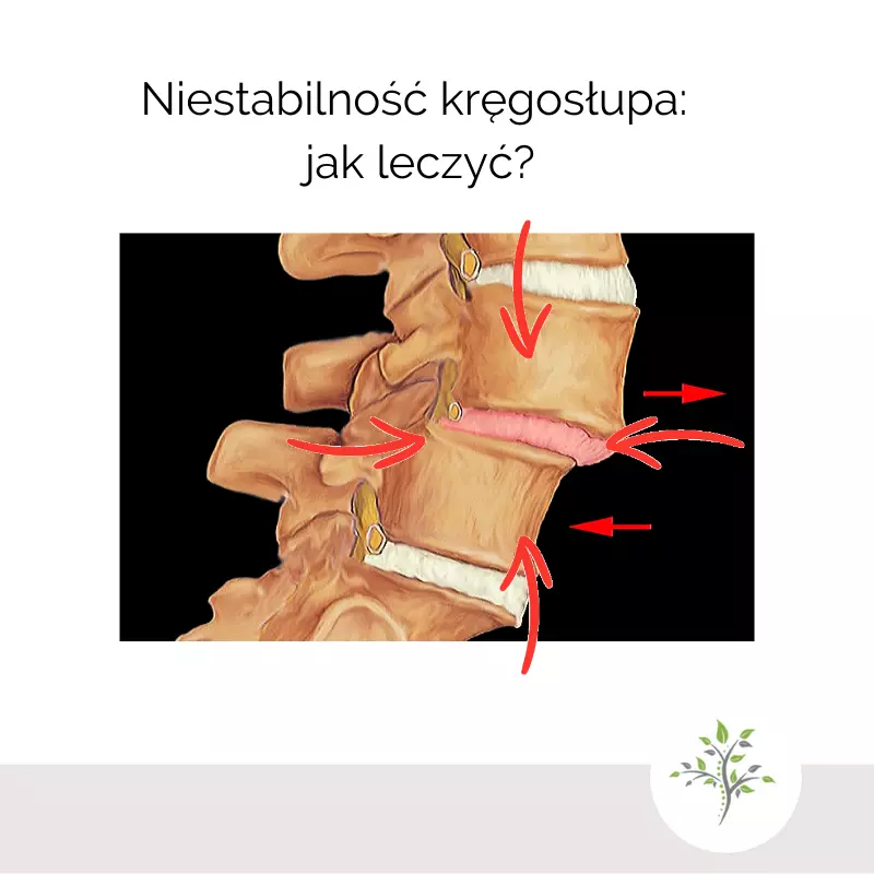 Niestabilność kręgosłupa: jak leczyć?