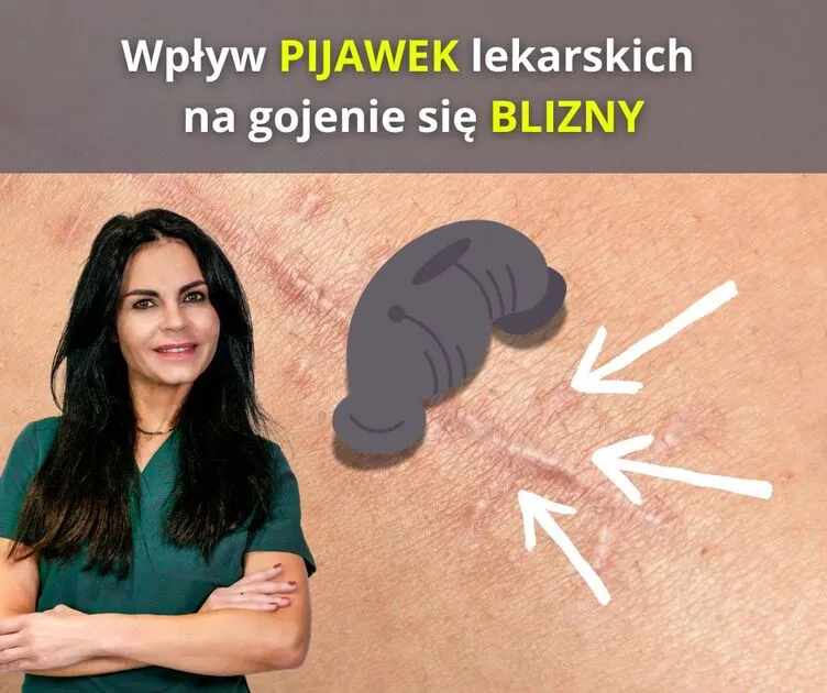 Pijawki medyczne stosowane w hirudoterapii na blizny pooperacyjne w gabinecie fizjoterapii w Szczecinie.