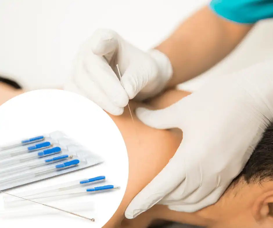 Suche igłowanie (dry needling) – Szczecin