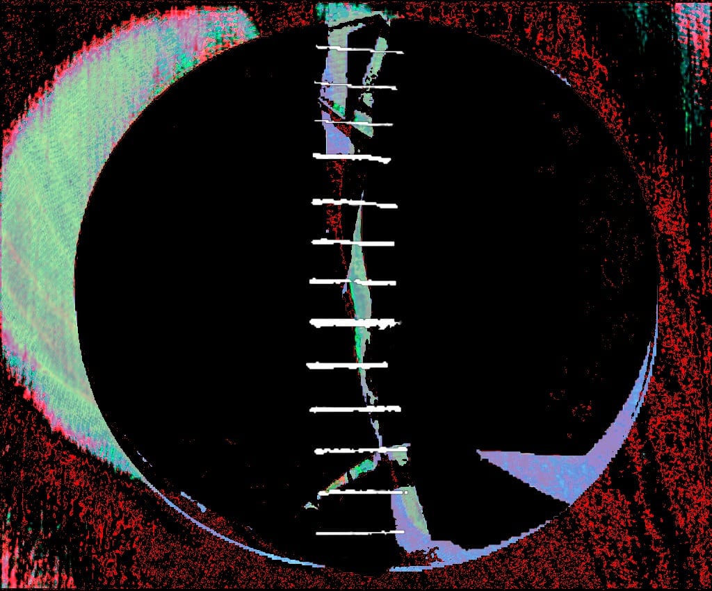 spinal hole