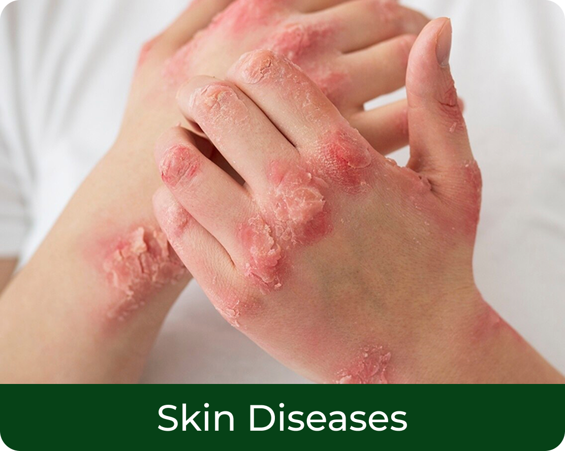 Skin Diseases