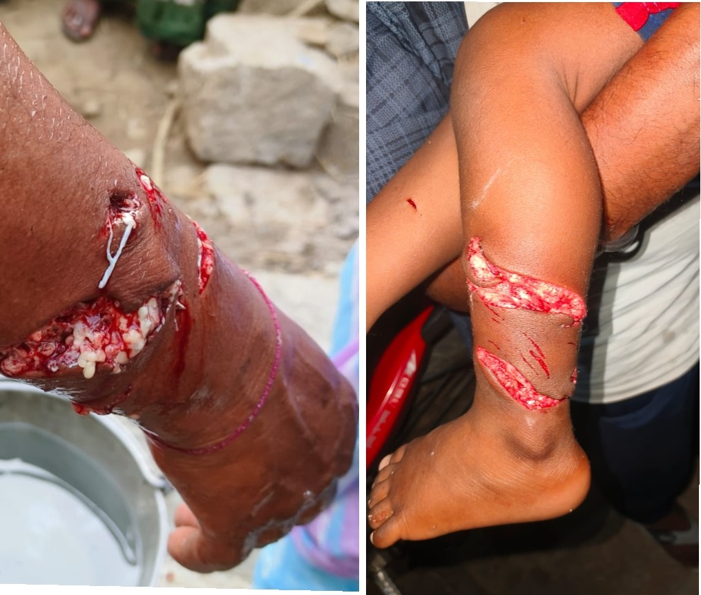 Stray Dog Attack Injures Villagers in Jannaram