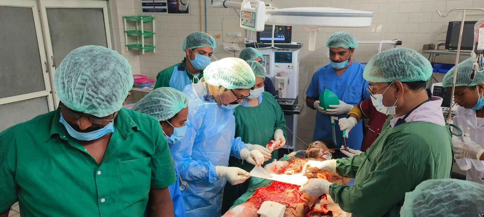 Medical team at Bhadrachalam Area Hospital following a successful complex surgery on a patient with severe burn injuries caused by electrocution.