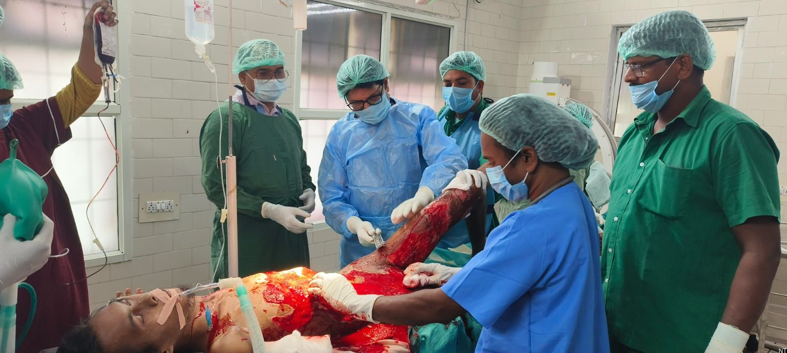 Medical team at Bhadrachalam Area Hospital following a successful complex surgery on a patient with severe burn injuries caused by electrocution.