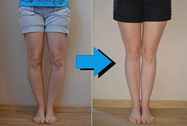 Bow Legs No More Review 2026: Does This Non-Surgical Fix Really Work?