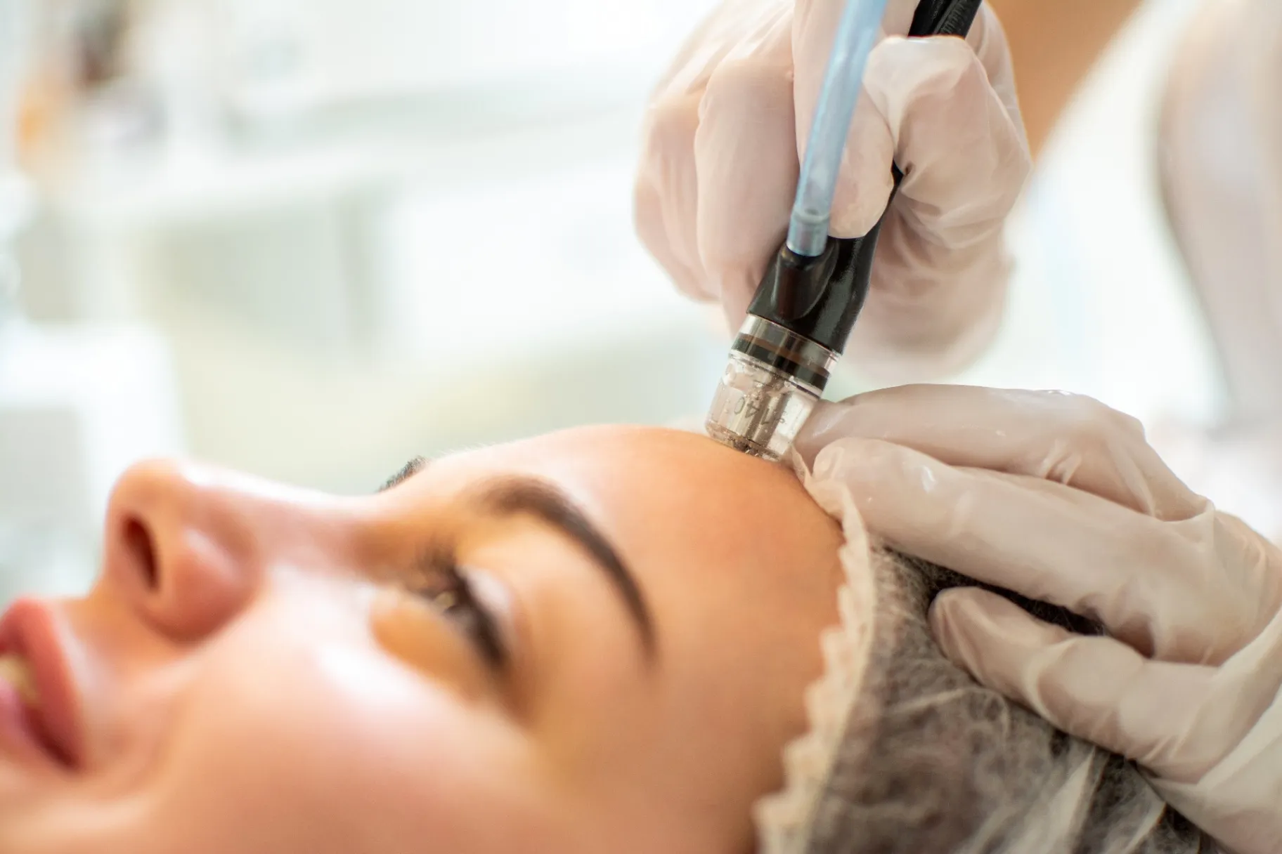 Advanced Dermabrasion Treatment