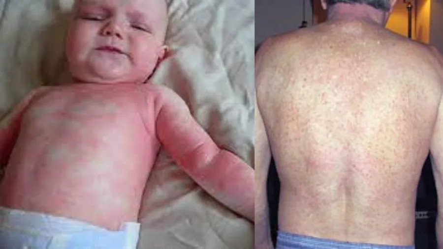 Skin irritation, one of the reactions some sensitive individuals associate with chlorinated and chloraminated tap water
