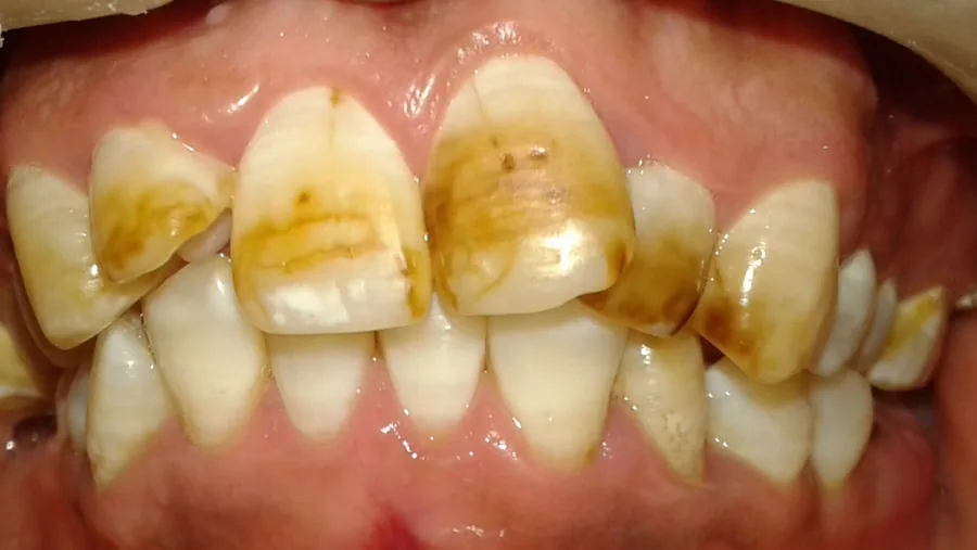 Teeth showing moderate dental fluorosis — the white-and-brown mottling that first hinted at fluoride's effect on enamel
