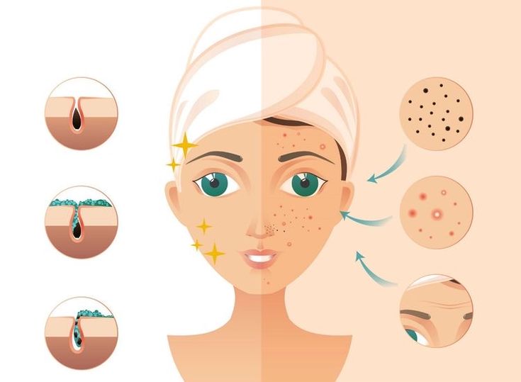 peeling nedir