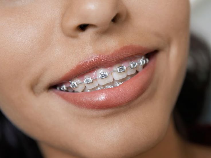 Braket Nedir? Çeşitleri ve Kullanımı Hakkında Bilgiler image