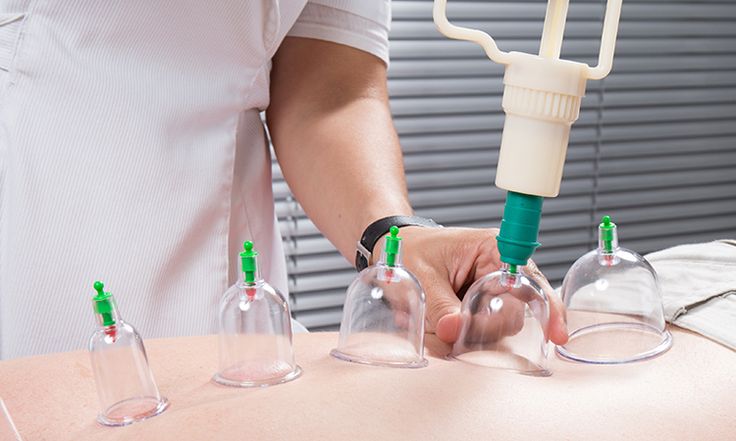 Hacamat Nedir? Nasıl Yapılır, Ne Amaçla Uygulanır? image