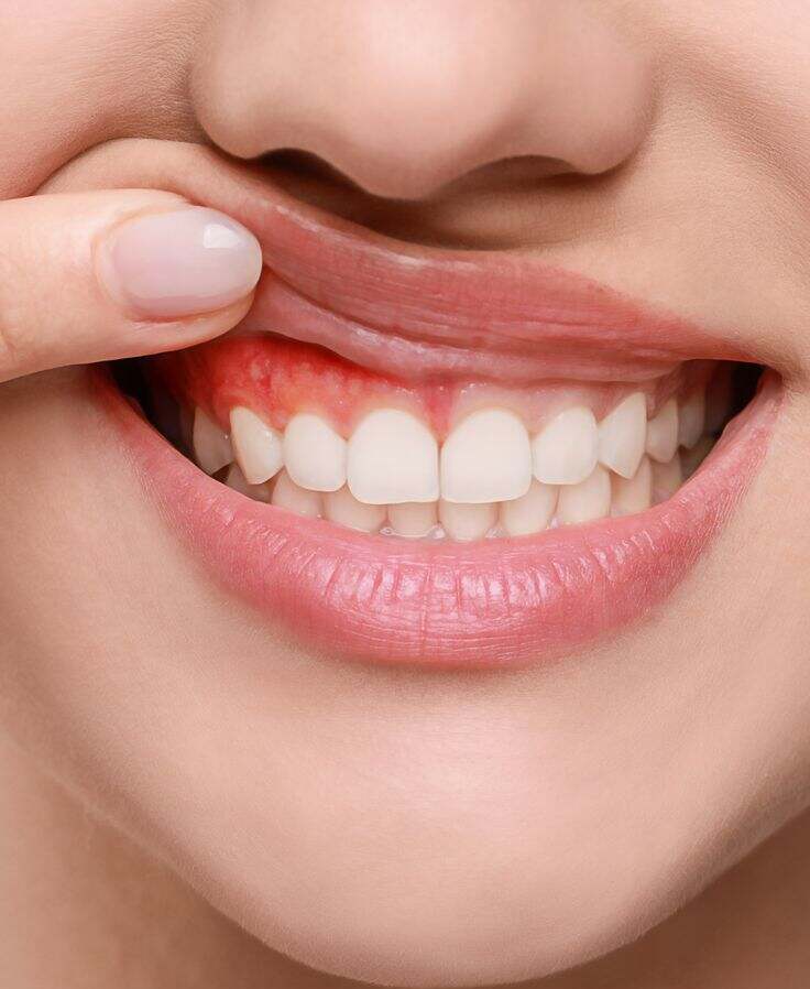 Periodontoloji Nedir? Diş Eti Hastalıkları & Tedavisi image