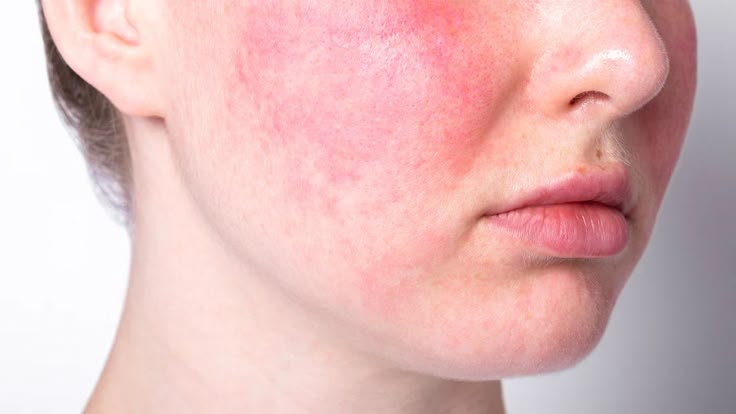 Roza Krem Nedir? Ne İşe Yarar, Yüze Sürülür mü? image