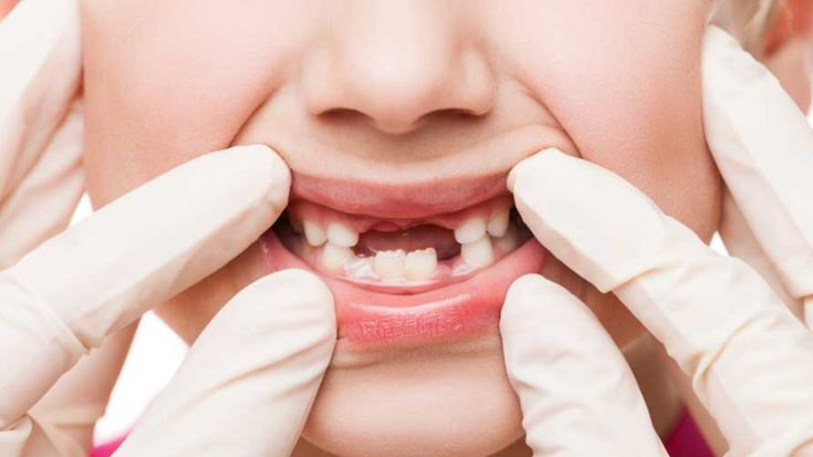 Rüyada Diş Kırılması Ne Anlama Gelir? Nedir?