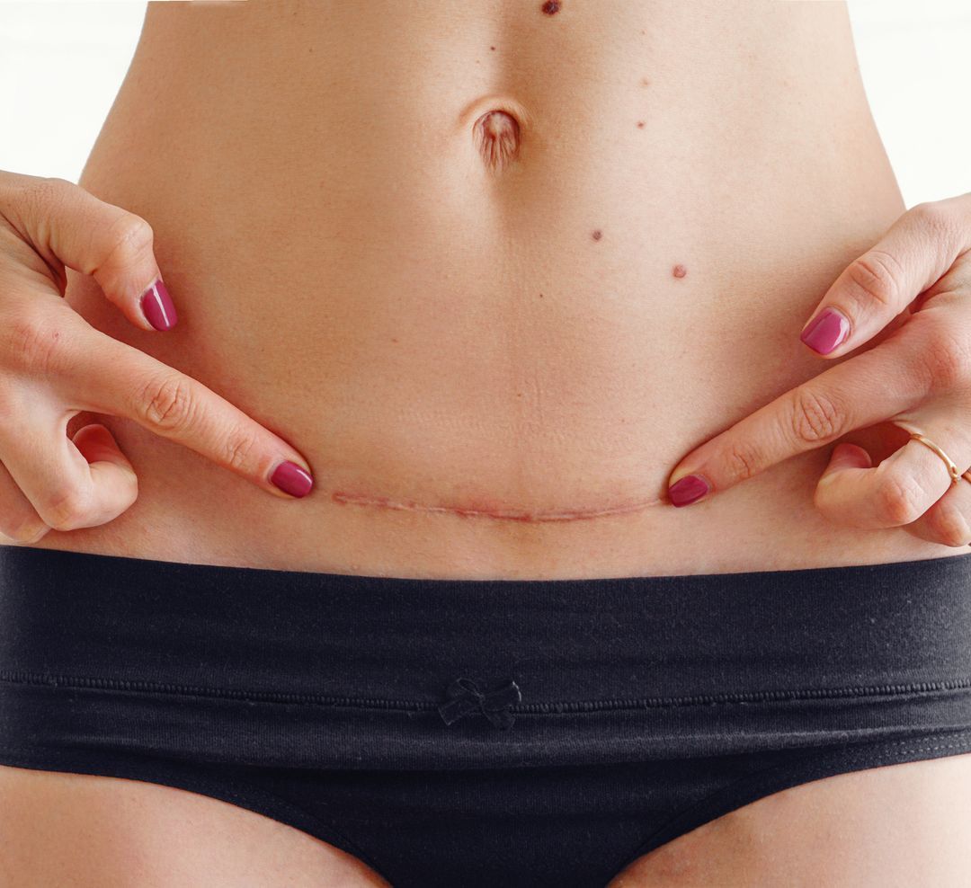 A close-up of a woman with an abdominal hysterectomy scar