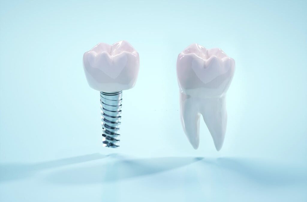 Tips for Taking Care of Your Dental Bridge feature image