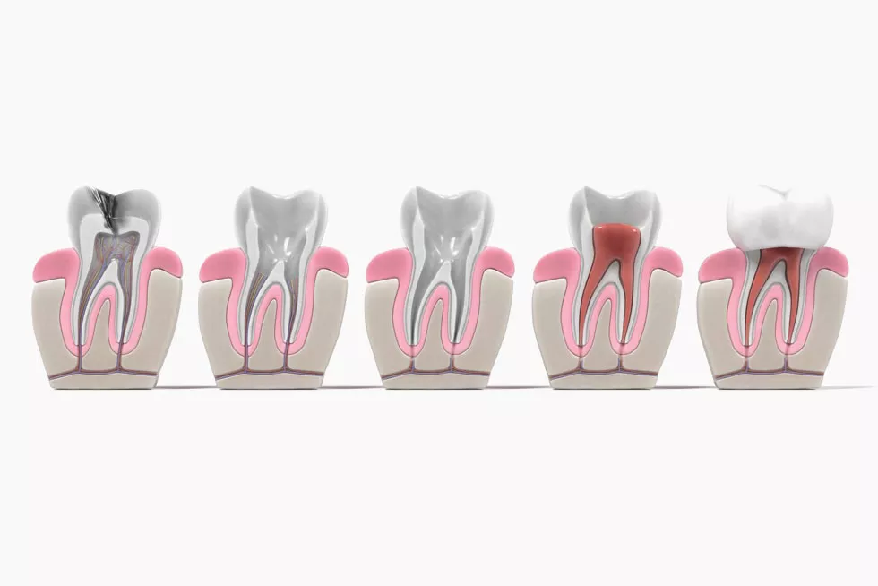 Root Canal Therapy in Markham: Saving Your Tooth and Relieving Pain feature image