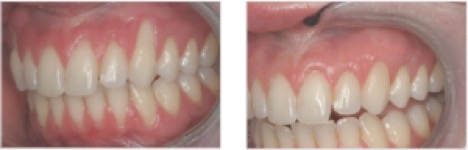 woman missing tooth