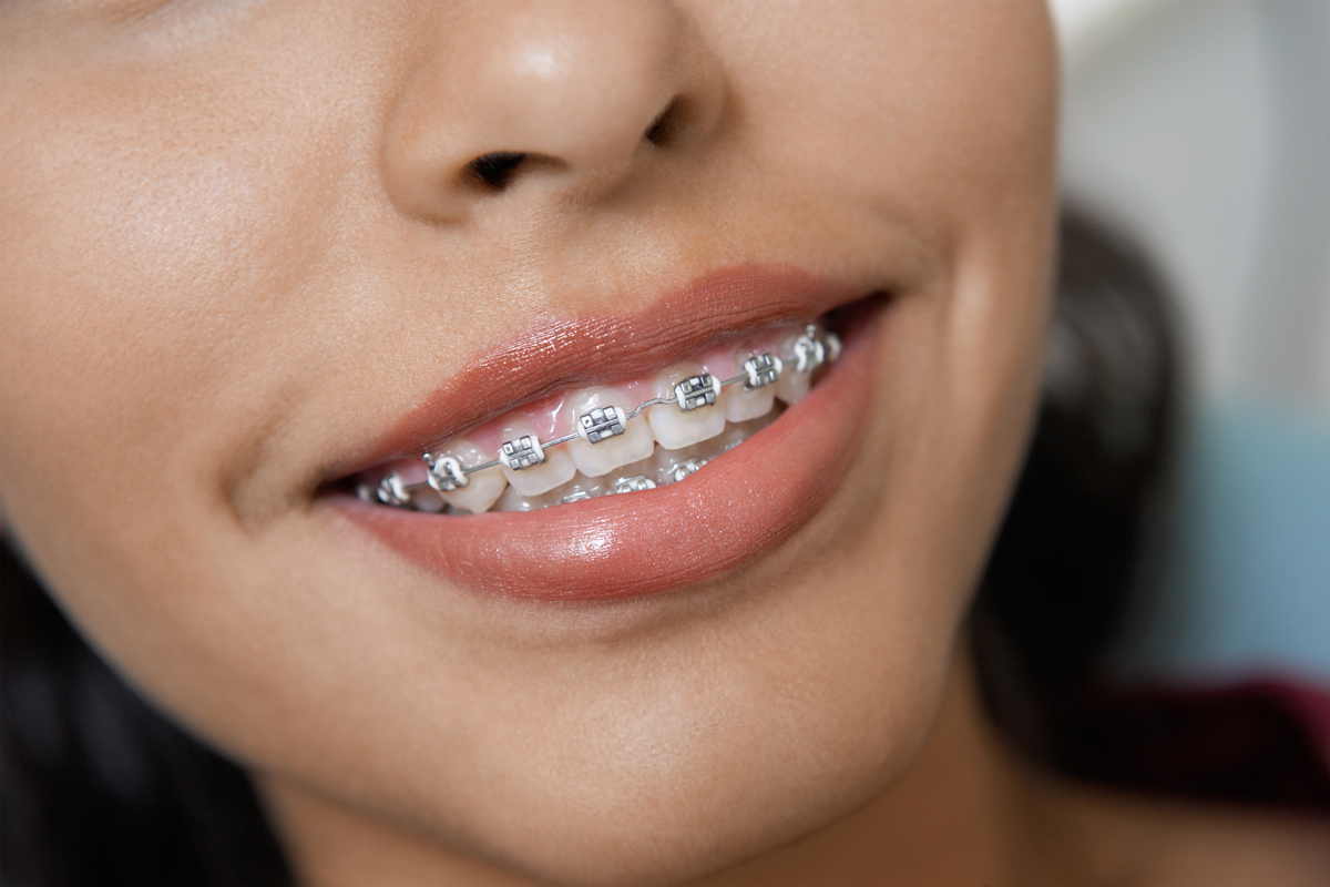 A patient's smile showing their braces.