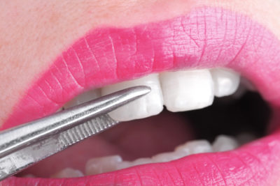 woman getting porcelain veneers