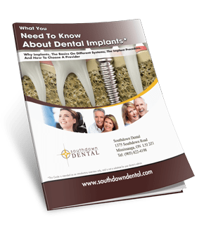 Dental Implants Guide