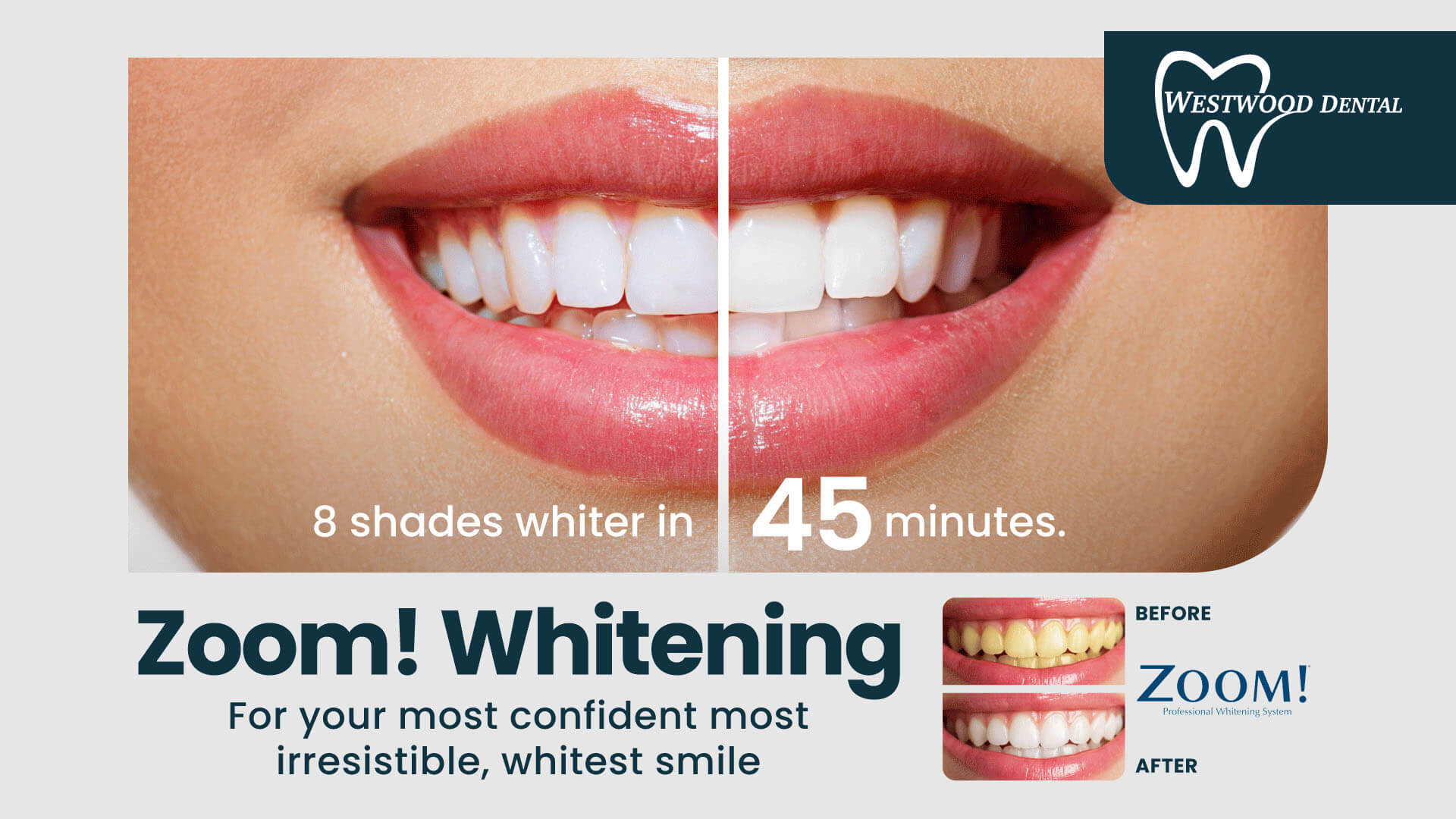 8 shades whiter in 45 minutes. 'Zoom!' Whitening. For your most confident most irresistible, whitest smile.