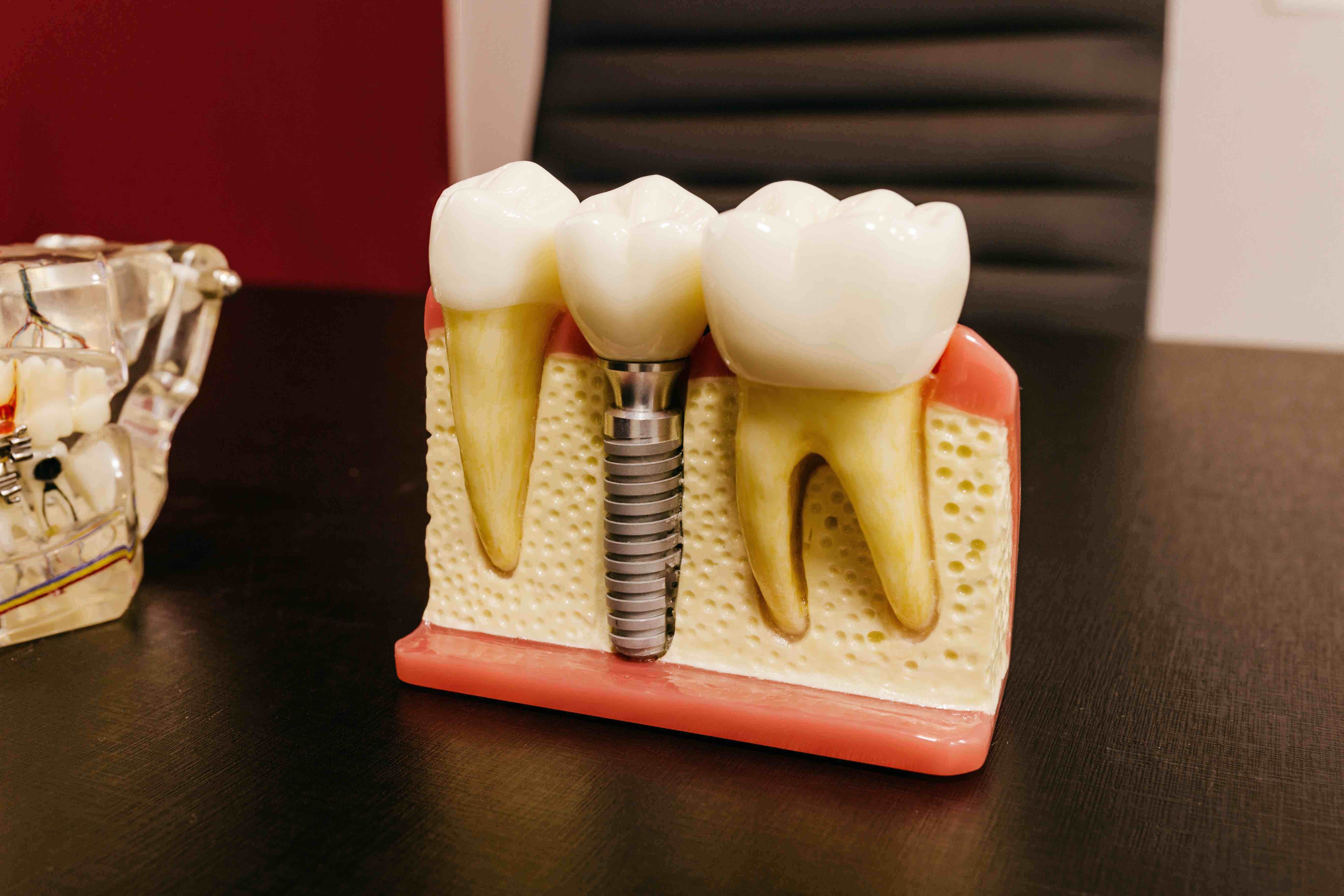 A model of dental implants.