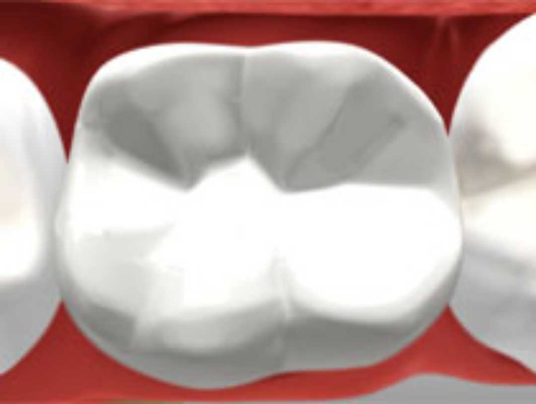 bonded fillings and inlays 2