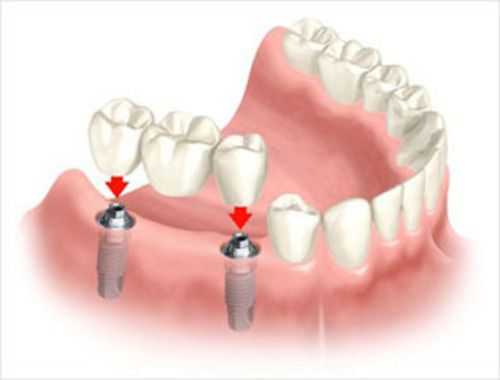 An illustration of a dental bridge.