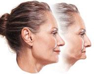 older women with weak jaw in one picture and strong jaw in another picture 