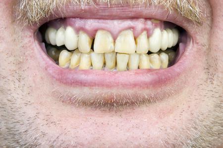 man with yellow teeth and gum disease 