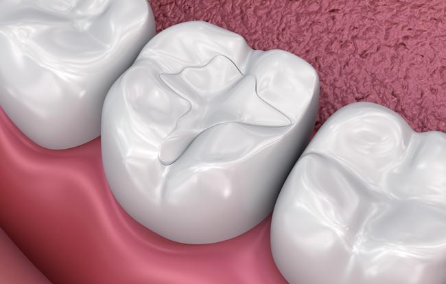 Tooth-Coloured Fillings